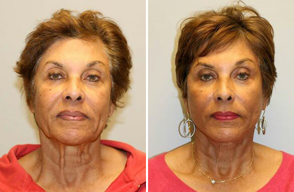 before and after of older brunette patients after dermal fillers