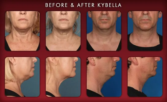 Before and after Kybella treatments in Palo Alto at Hessler Plastic Surgery