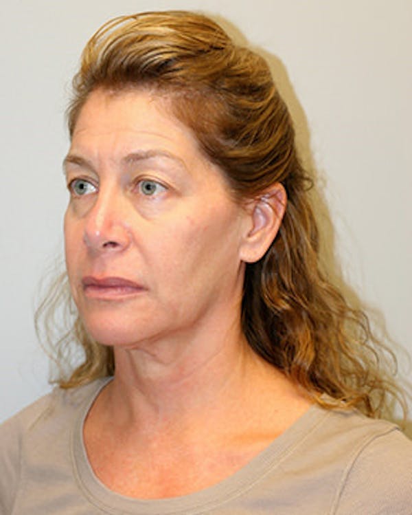 Facelift Before & After Gallery - Patient 12059270 - Image 3