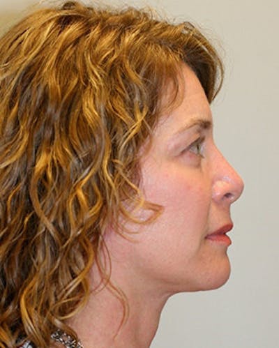 Facelift Before & After Gallery - Patient 12059270 - Image 6