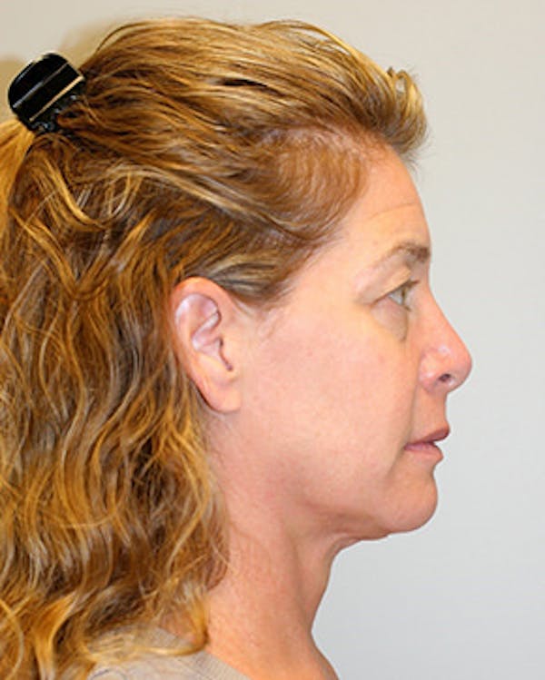 Facelift Before & After Gallery - Patient 12059270 - Image 5