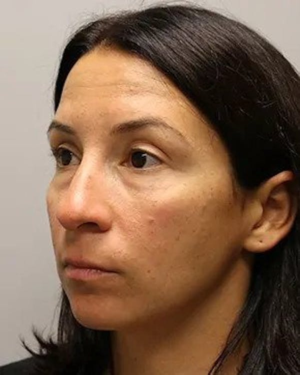 Blepharoplasty Before & After Gallery - Patient 12059153 - Image 5