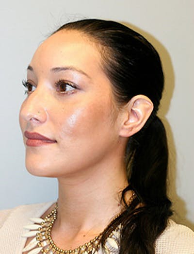 Laser Resurfacing Before & After Gallery - Patient 12059381 - Image 4
