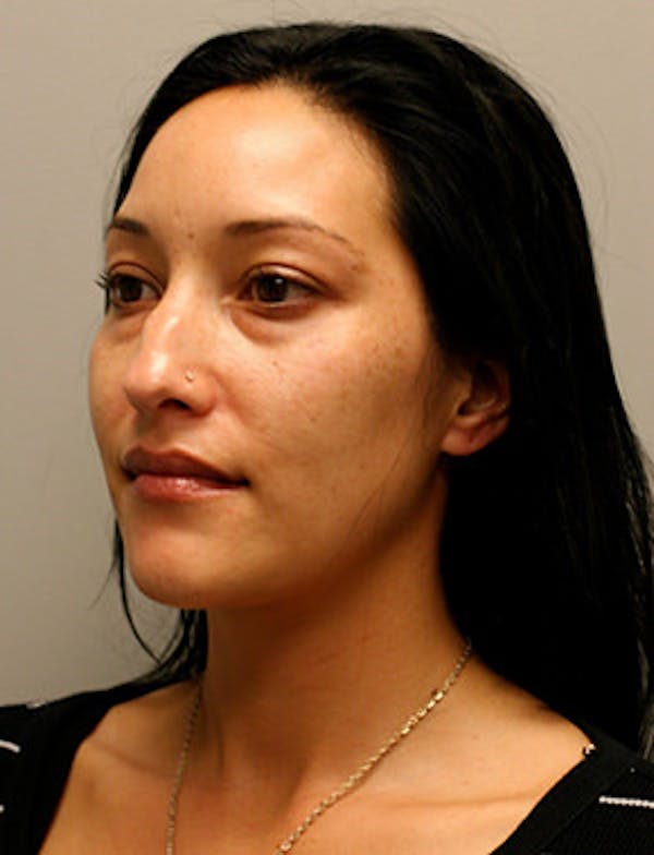Blepharoplasty Before & After Gallery - Patient 12059161 - Image 3