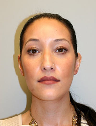 Blepharoplasty Before & After Gallery - Patient 12059161 - Image 2