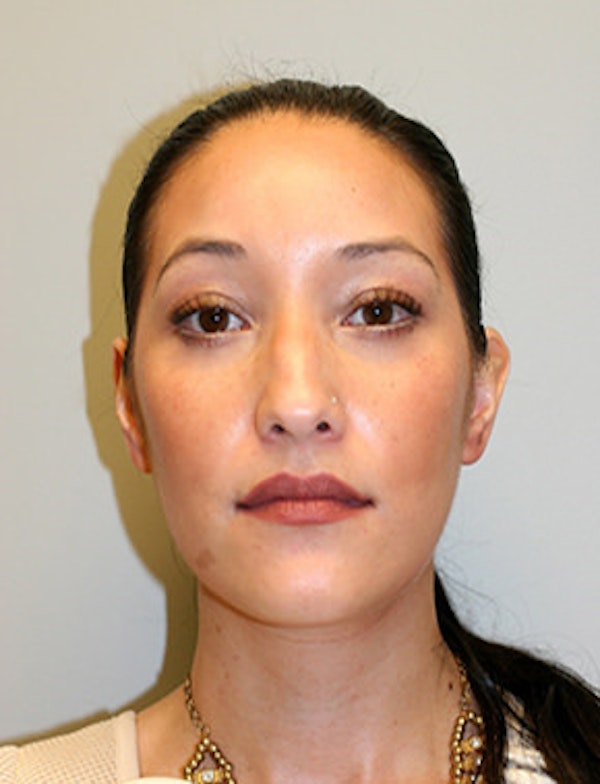 Before and after Blepharoplasty in the Bay Area at Hessler Plastic Surgery