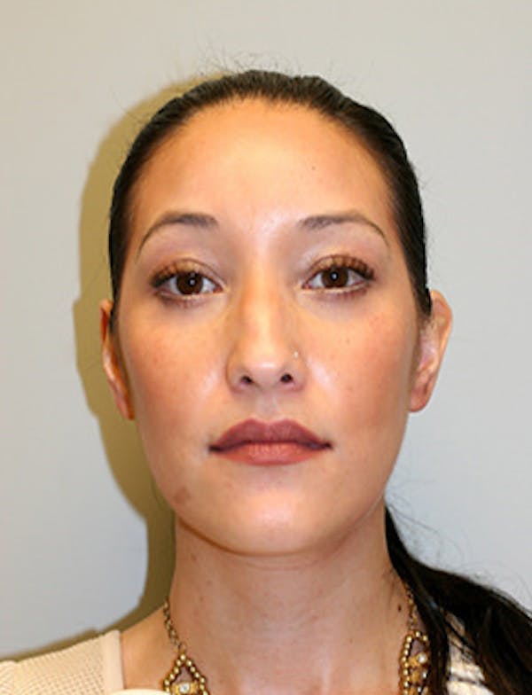 Laser Resurfacing Before & After Gallery - Patient 12059381 - Image 2