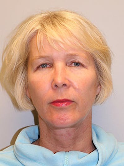 Facelift Before & After Gallery - Patient 12059269 - Image 2