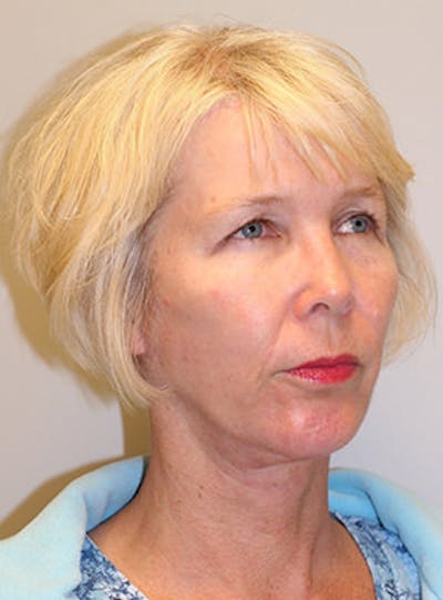 Facelift Before & After Gallery - Patient 12059269 - Image 4