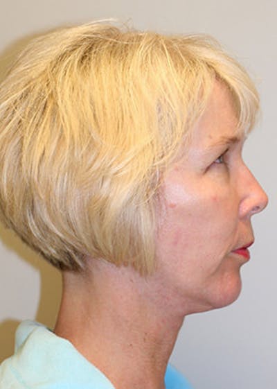 Facelift Before & After Gallery - Patient 12059269 - Image 6