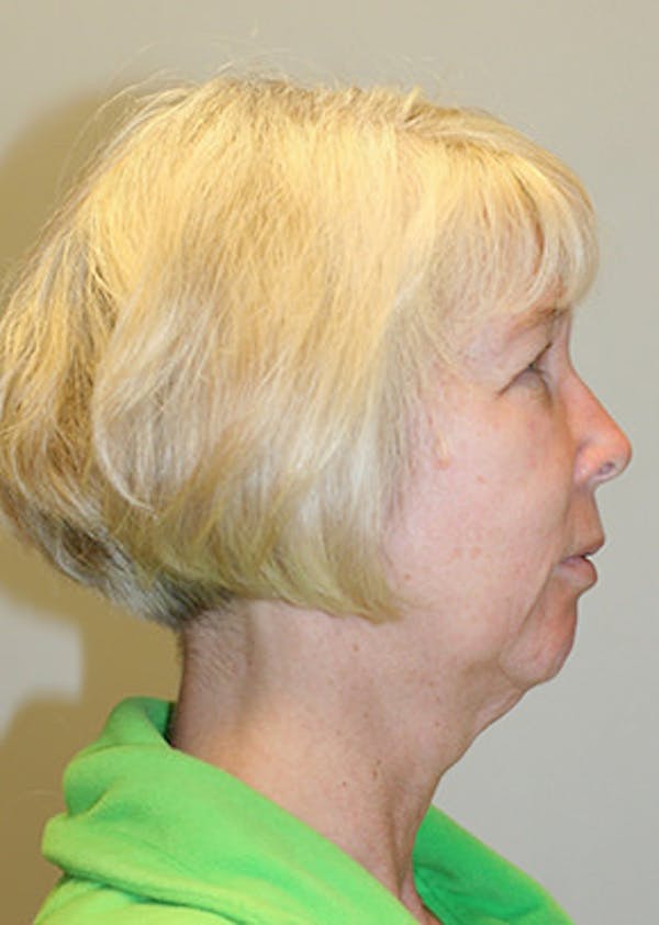 Facelift Before & After Gallery - Patient 12059269 - Image 5