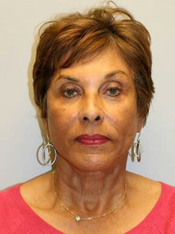 Facelift Before & After Gallery - Patient 12059300 - Image 2