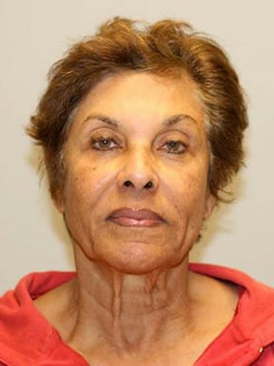 Facelift Before & After Gallery - Patient 12059300 - Image 1