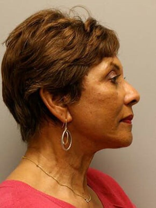 Facelift Before & After Gallery - Patient 12059300 - Image 4