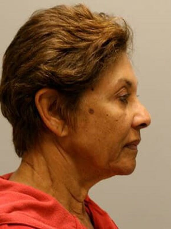 Facelift Before & After Gallery - Patient 12059300 - Image 3