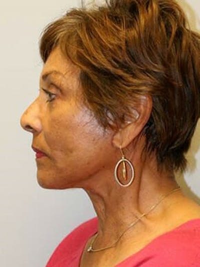Facelift Before & After Gallery - Patient 12059300 - Image 6
