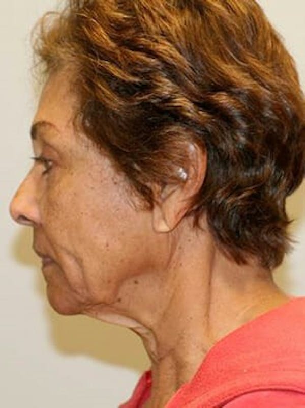 Facelift Before & After Gallery - Patient 12059300 - Image 5