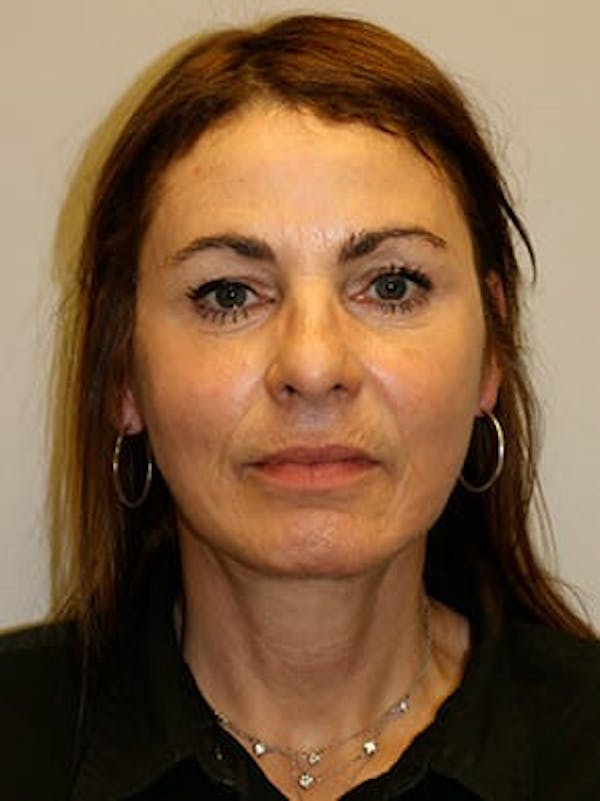 Facelift Before & After Gallery - Patient 12059314 - Image 2