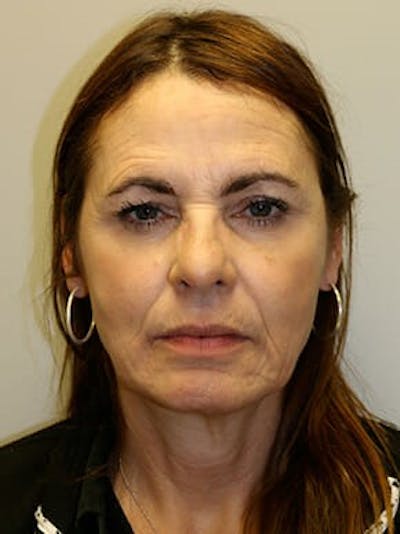 Facelift Before & After Gallery - Patient 12059314 - Image 1