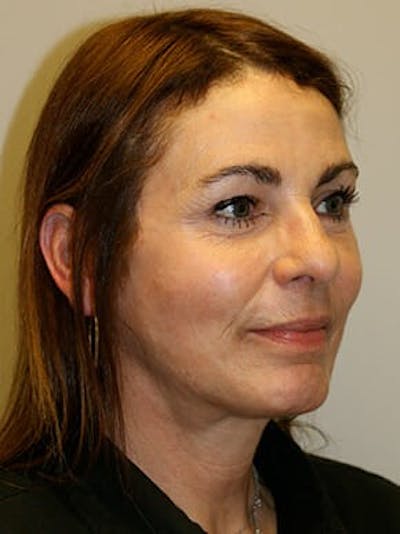 Facelift Before & After Gallery - Patient 12059314 - Image 4
