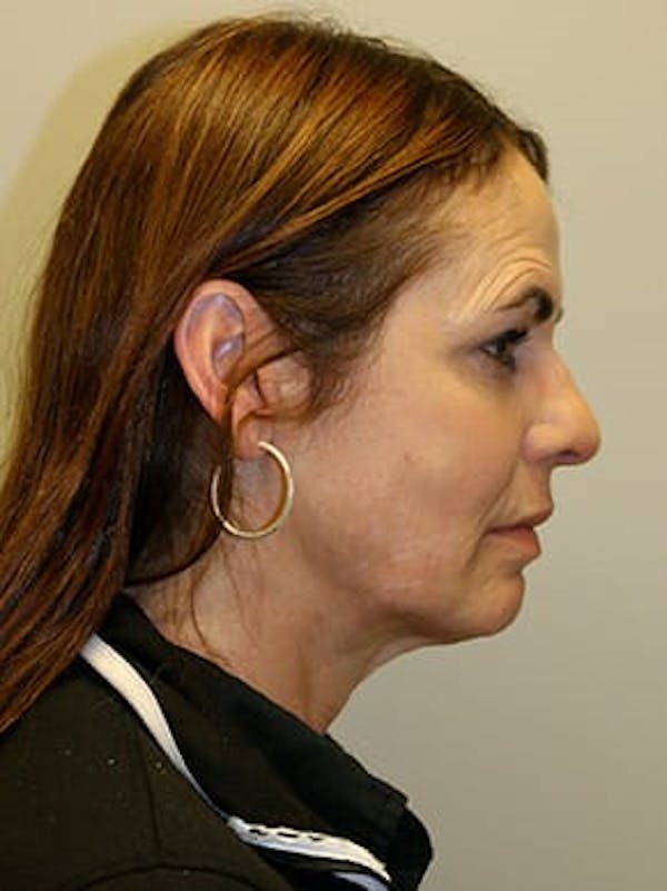 Facelift Before & After Gallery - Patient 12059314 - Image 5
