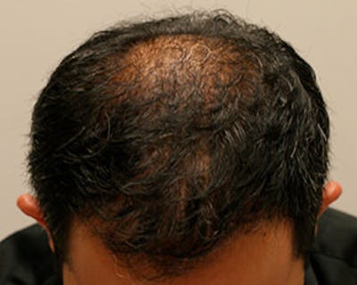 Hair Transplant Before & After Gallery - Patient 12059324 - Image 2