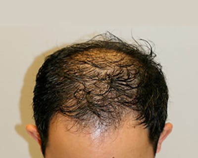 Hair Transplant Before & After Gallery - Patient 12059324 - Image 1
