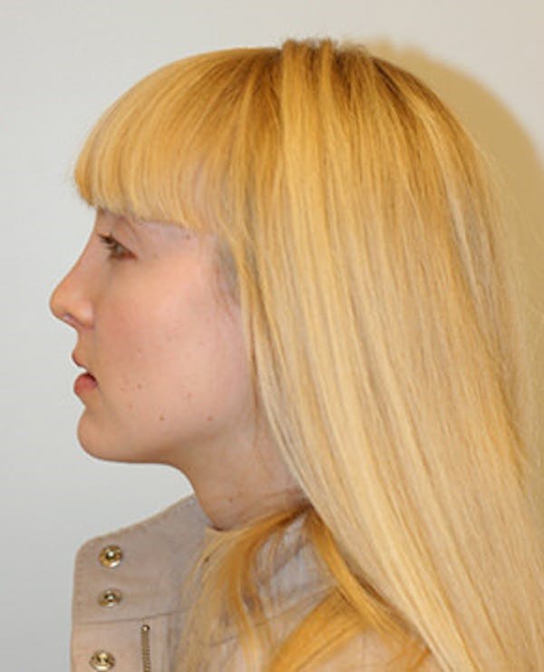 Rhinoplasty Before & After Gallery - Patient 12059457 - Image 4