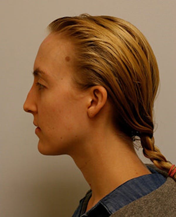 Rhinoplasty Before & After Gallery - Patient 12059457 - Image 3