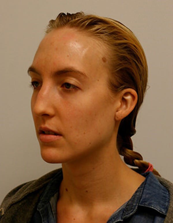 Rhinoplasty Before & After Gallery - Patient 12059457 - Image 5