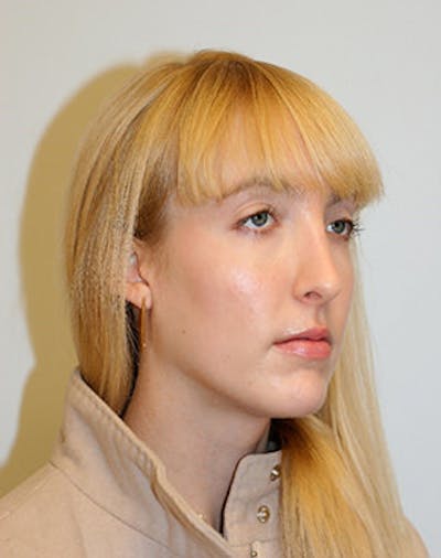 Rhinoplasty Before & After Gallery - Patient 12059457 - Image 2