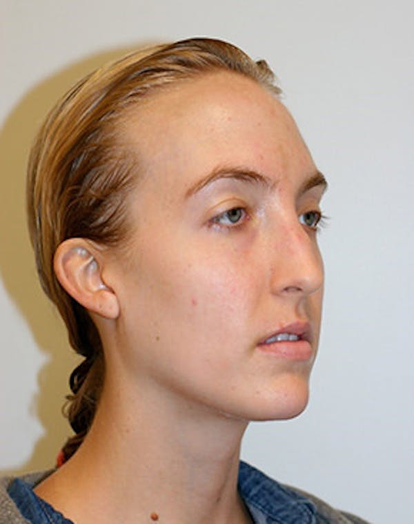 Rhinoplasty Before & After Gallery - Patient 12059457 - Image 1