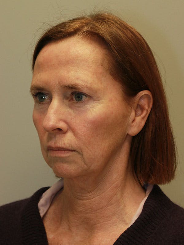 Facelift Before & After Gallery - Patient 122268664 - Image 3