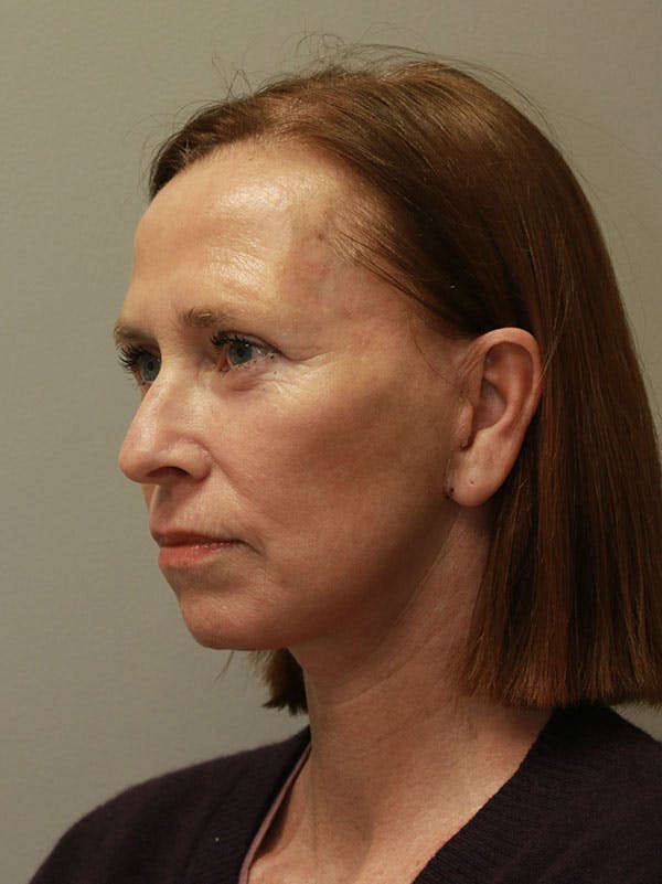 Facelift Before & After Gallery - Patient 122268664 - Image 4
