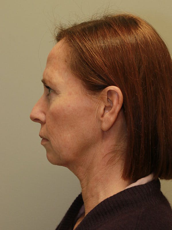 Facelift Before & After Gallery - Patient 122268664 - Image 5
