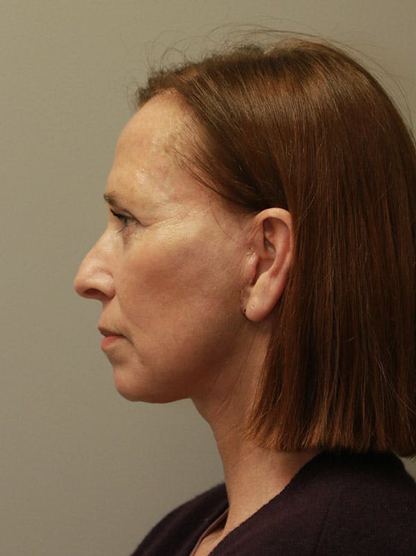 Facelift Before & After Gallery - Patient 122268664 - Image 6