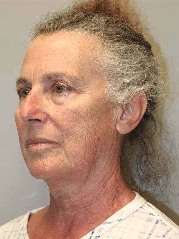 Facelift Before & After Gallery - Patient 143826650 - Image 3