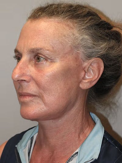 Facelift Before & After Gallery - Patient 143826650 - Image 4
