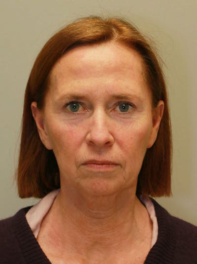 Facelift Before & After Gallery - Patient 122268664 - Image 1