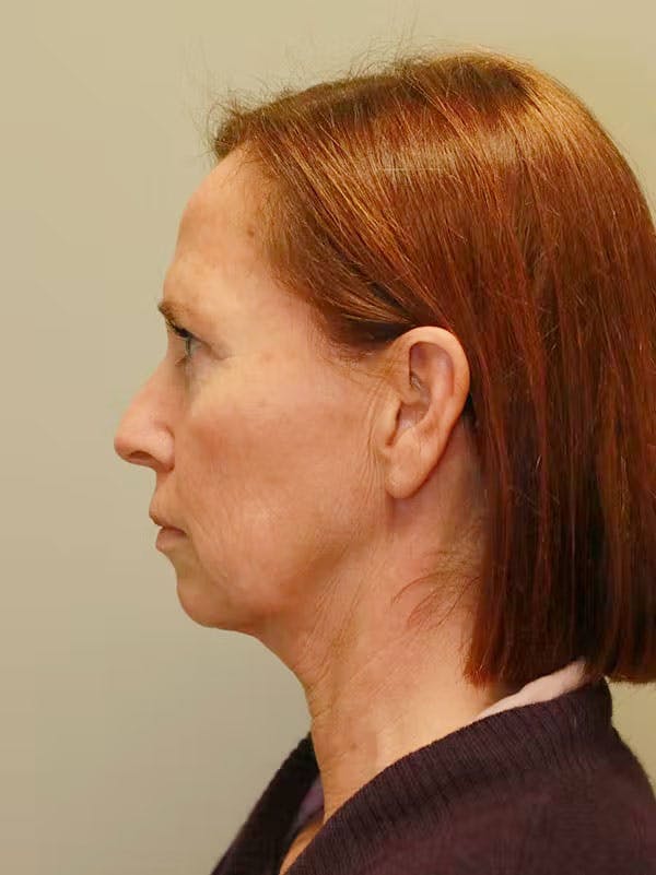 Facelift Before & After Gallery - Patient 122268664 - Image 5