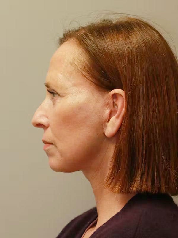 Facelift Before & After Gallery - Patient 122268664 - Image 6