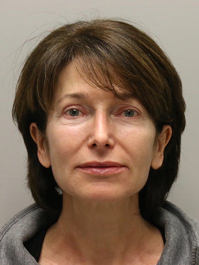 Facelift Before & After Gallery - Patient 144196984 - Image 1