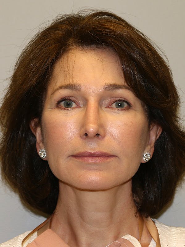 Facelift Before & After Gallery - Patient 144196984 - Image 2