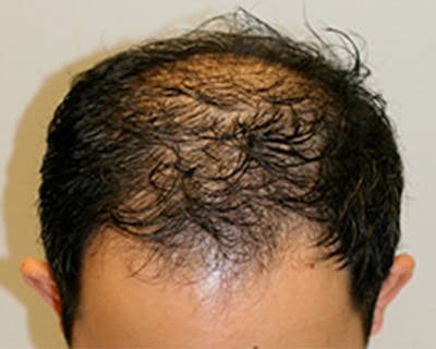 Hair Transplant Before & After Gallery - Patient 12059324 - Image 1