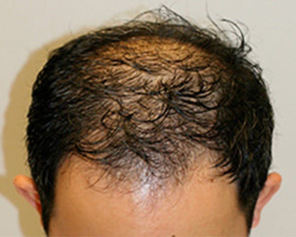 Hair Transplant Before & After Gallery - Patient 12059324 - Image 1