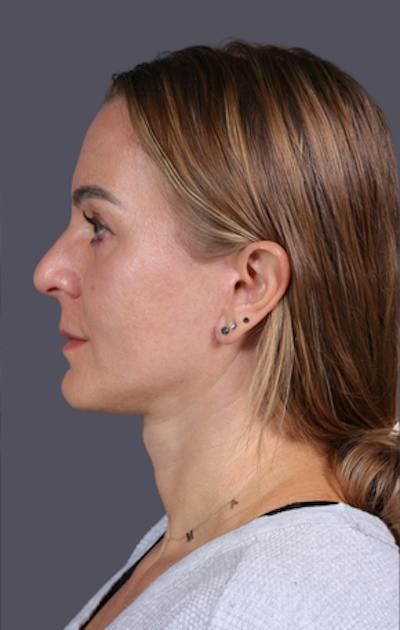 Facelift Before & After Gallery - Patient 121801 - Image 10