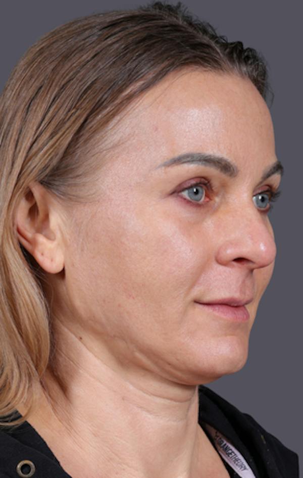 Facelift Before & After Gallery - Patient 121801 - Image 3
