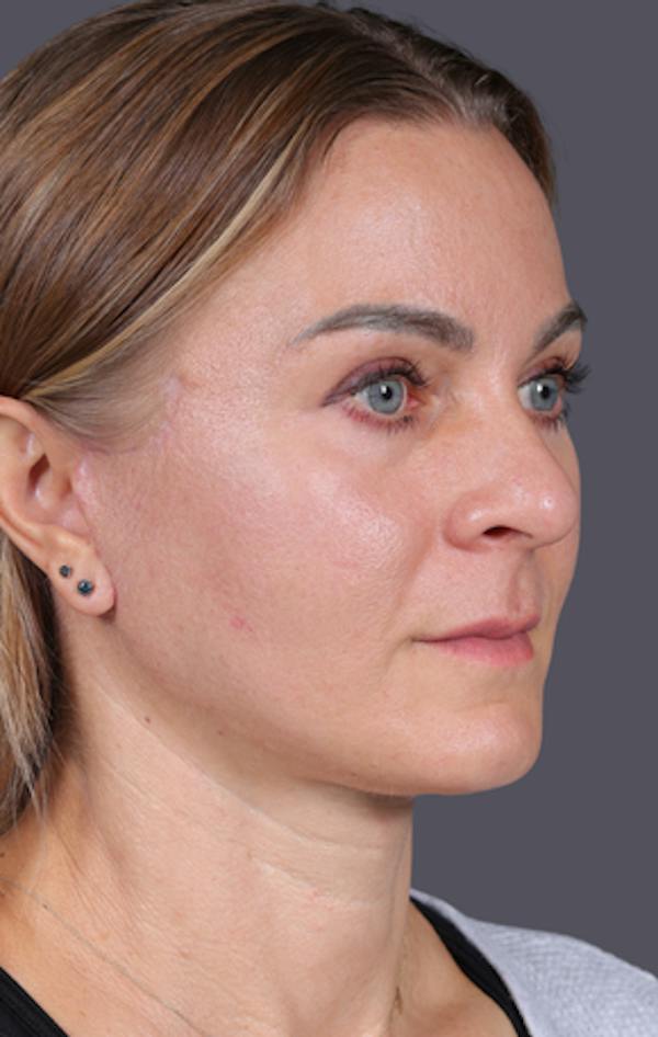 Facelift Before & After Gallery - Patient 121801 - Image 4