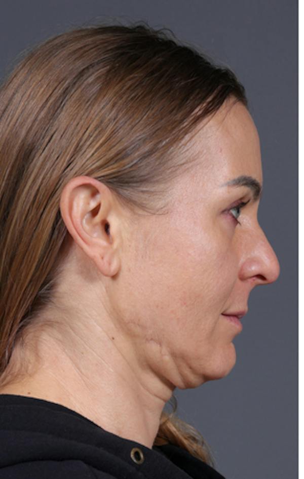 Facelift Before & After Gallery - Patient 121801 - Image 5