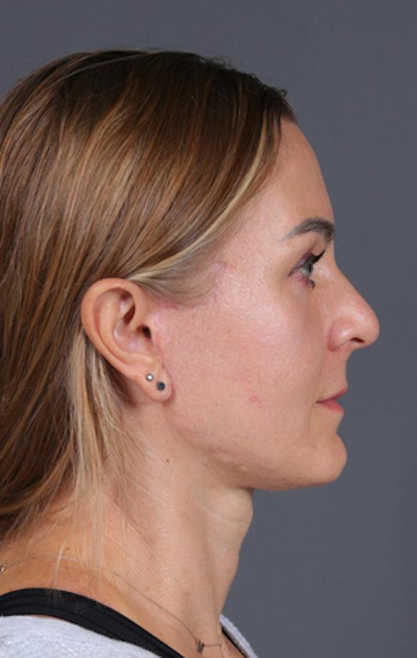 Facelift Before & After Gallery - Patient 121801 - Image 6